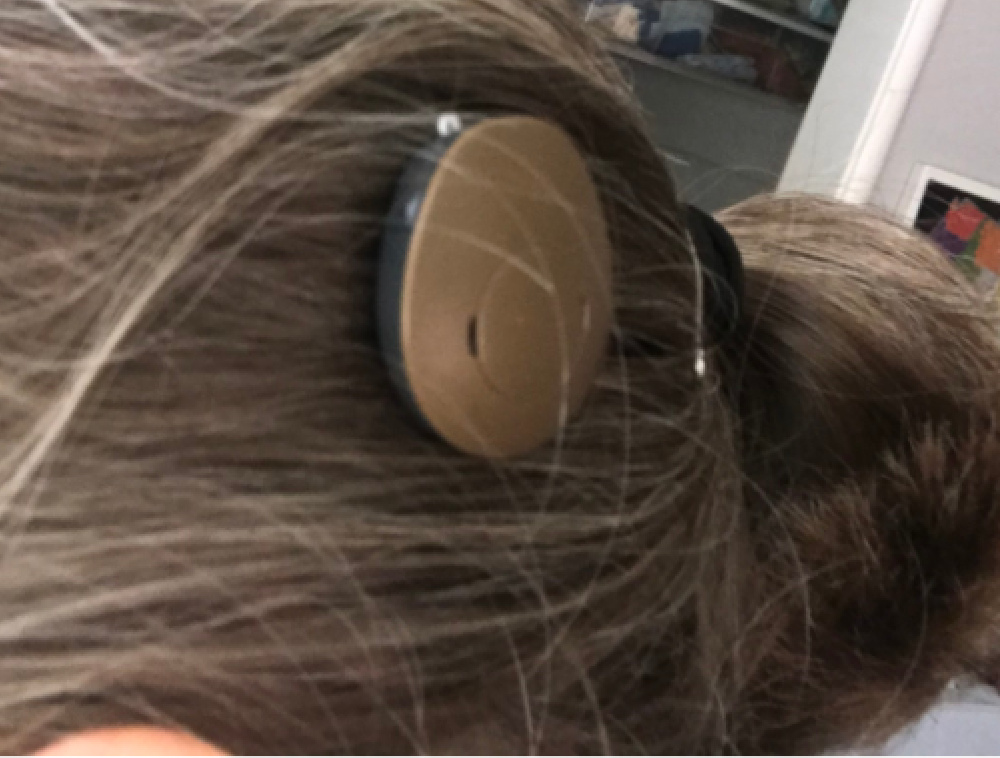 Bone conduction implant - Samba
